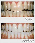 Zaehne vor und nach dem Zahnaufhellung durch ein Bleachingverfahren