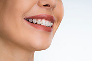 laechender Mund einer Frau mit weißer Zahnspange